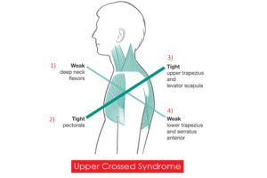 Janda's Upper Crossed Syndrome causes elevated, rounded shoulders, poor posture and pain the upper back and neck