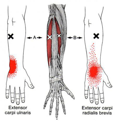 Wrist Pain - Forearm Overload... - West Suburban Pain Relief