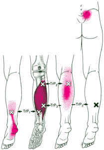 lower leg pain trigger point referrals soleus