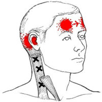 cluster headache - myofascial triggerpoint therapy