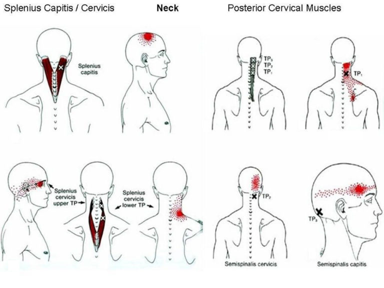 Headaches and Neck Muscles - Intro - West Suburban Pain Relief