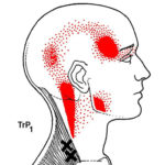 chronic headache pain myofascial therapy trigger point