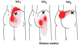 low back pain - gluteus medius, glute pain