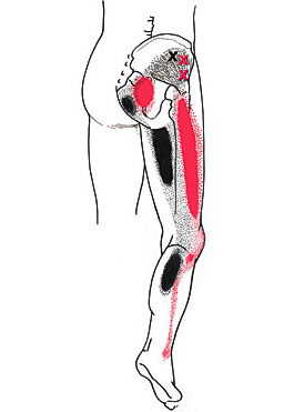 Trigger Point Gluteus Hip Pain