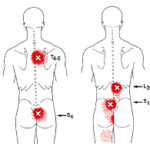 low back pain - multifidi