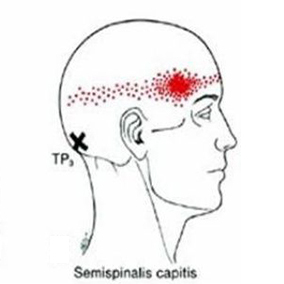 Cervicogenic Headache - Trigger Point Works - West Suburban Pain Relief