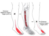 hammer toes and foot pain long toe extensor trigger point referral
