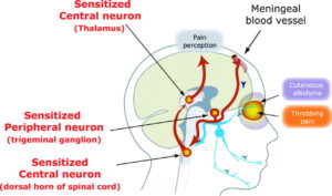 chronic headache central sensitization