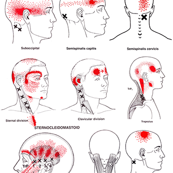 chronic headache pain myofascial therapy trigger point