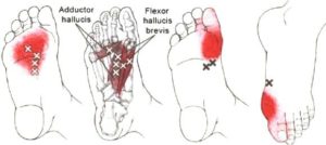 foot pain intrinsic muscles of the foot-deep