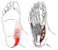 intrinsic foot muscles trigger points