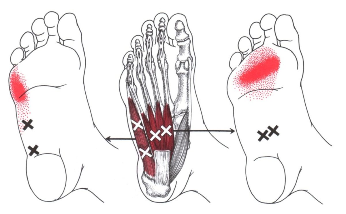 Foot pain? Intrinsic muscles trigger points? Try West Suburban Pain Relief!