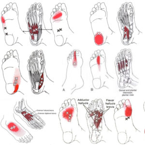 foot pain intrinsic muscles