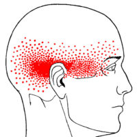 chronic headache pain myofascial treatment trigger point therapy
