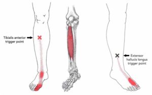 tibialis anterior trigger points big toe pain