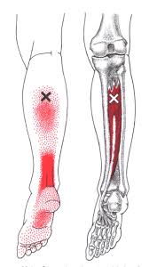 treatment of tibialis posterior heel pain