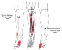 claw toes and foot pain long toe flexors trigger point referral
