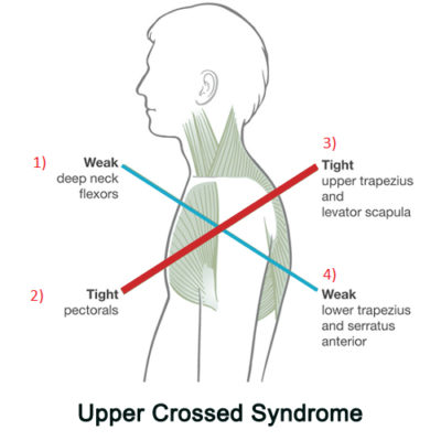 upper crossed syndrome and chronic pain