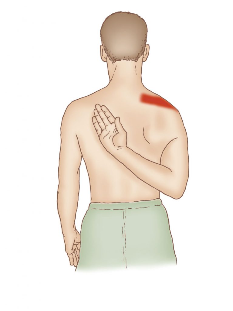 supraspinatus-muscle-arm-raising-pain-west-suburban-pain-relief