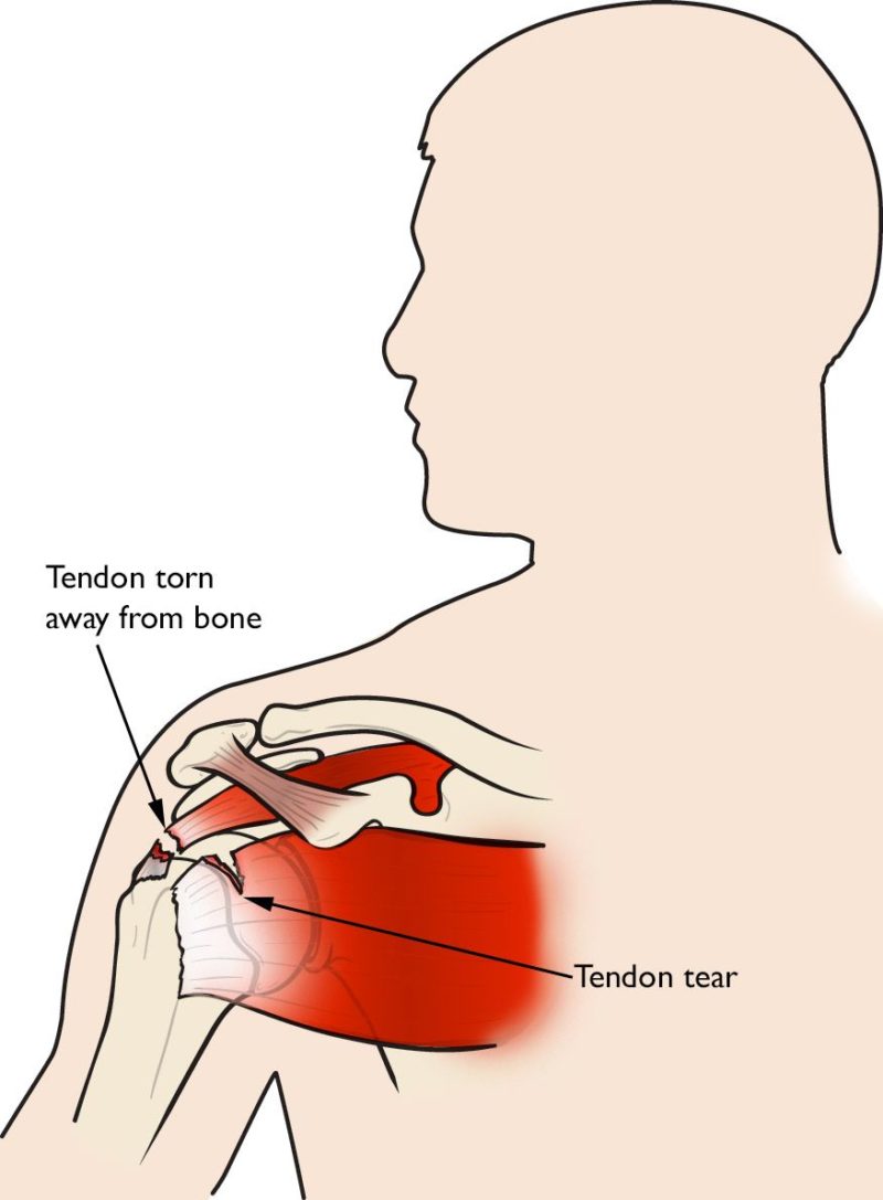 Treatment of Rotator Cuff Injuries - West Suburban Pain Relief