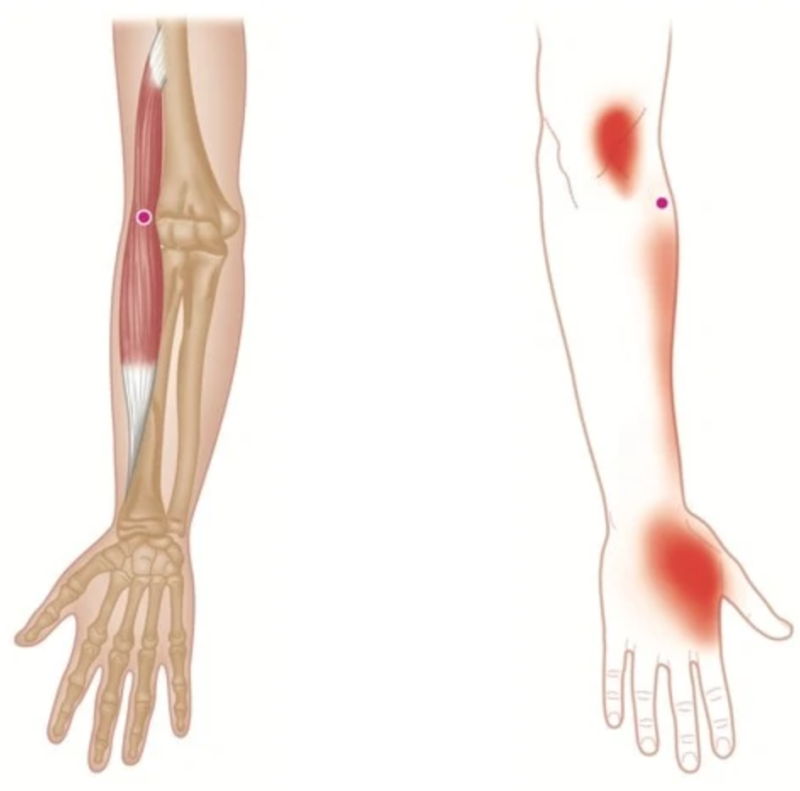 brachioradialis-hand-and-forearm-pain-west-suburban-pain-relief